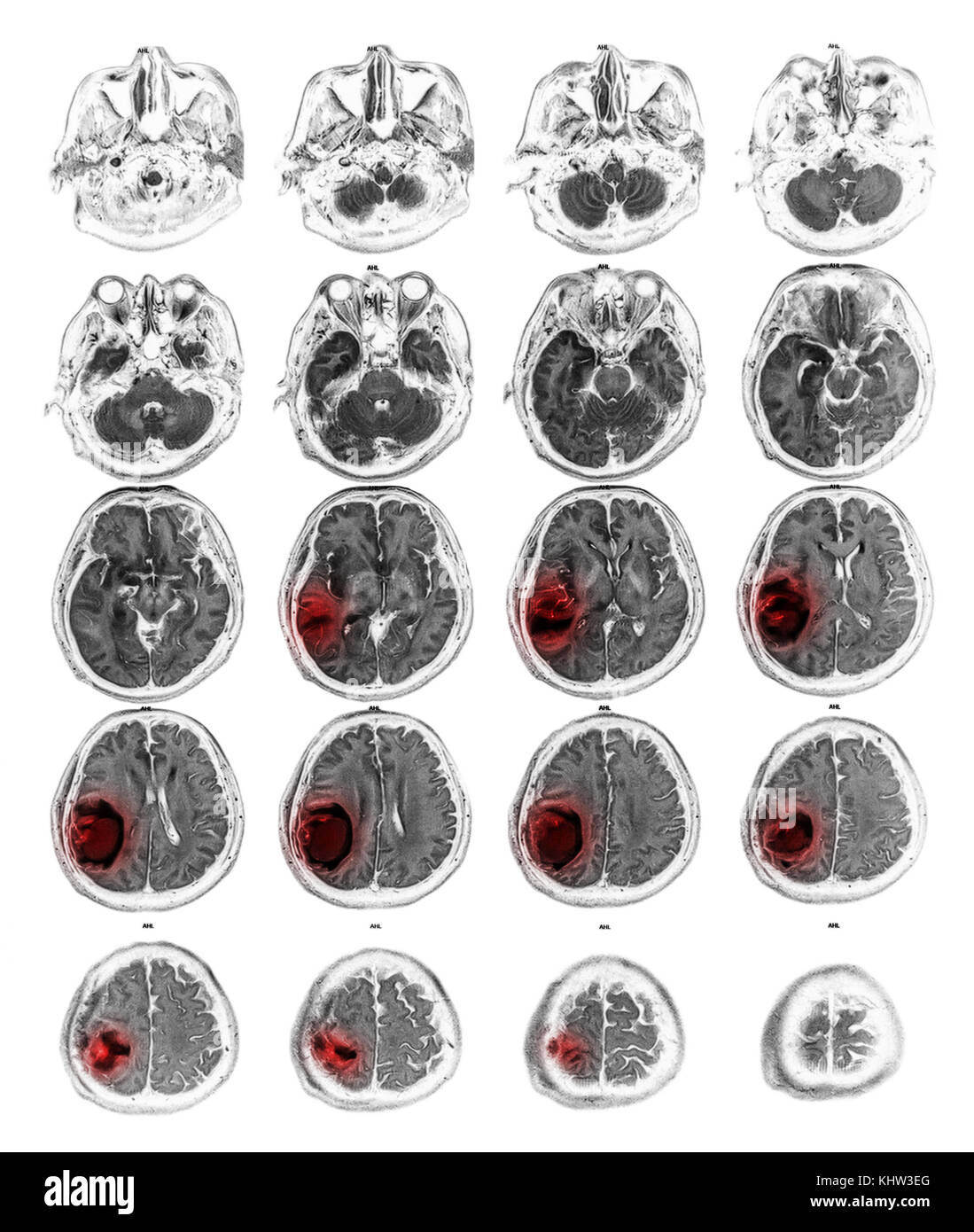 Voir irm de cerveau Tumeur au cerveau droit au lobe pariétal . Banque D'Images