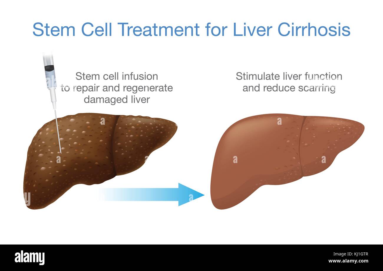 La cirrhose hépatique Le traitement par cellules souches. Illustration de Vecteur
