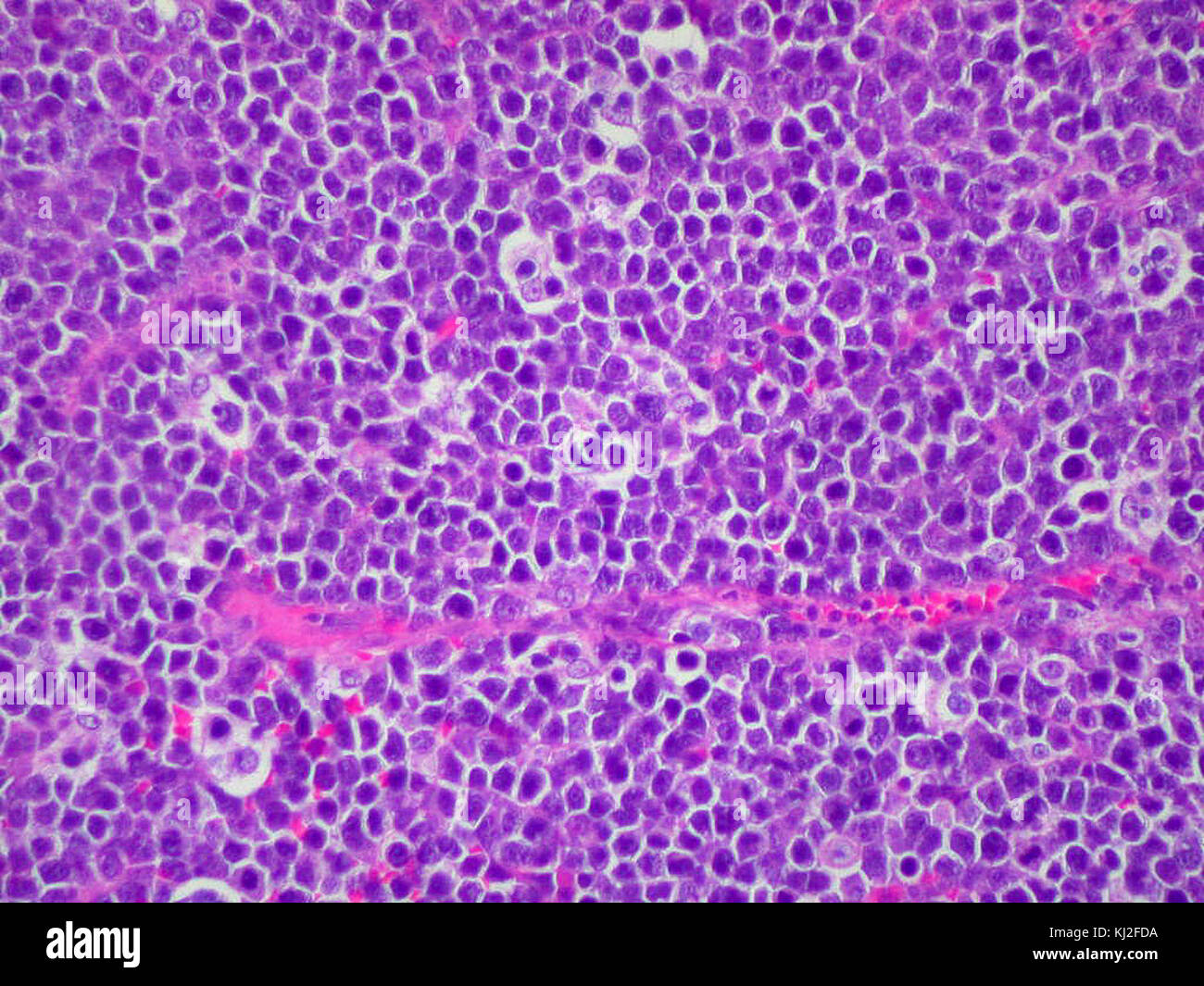 Test De Lymphome Banque Dimages Dtoures Alamy