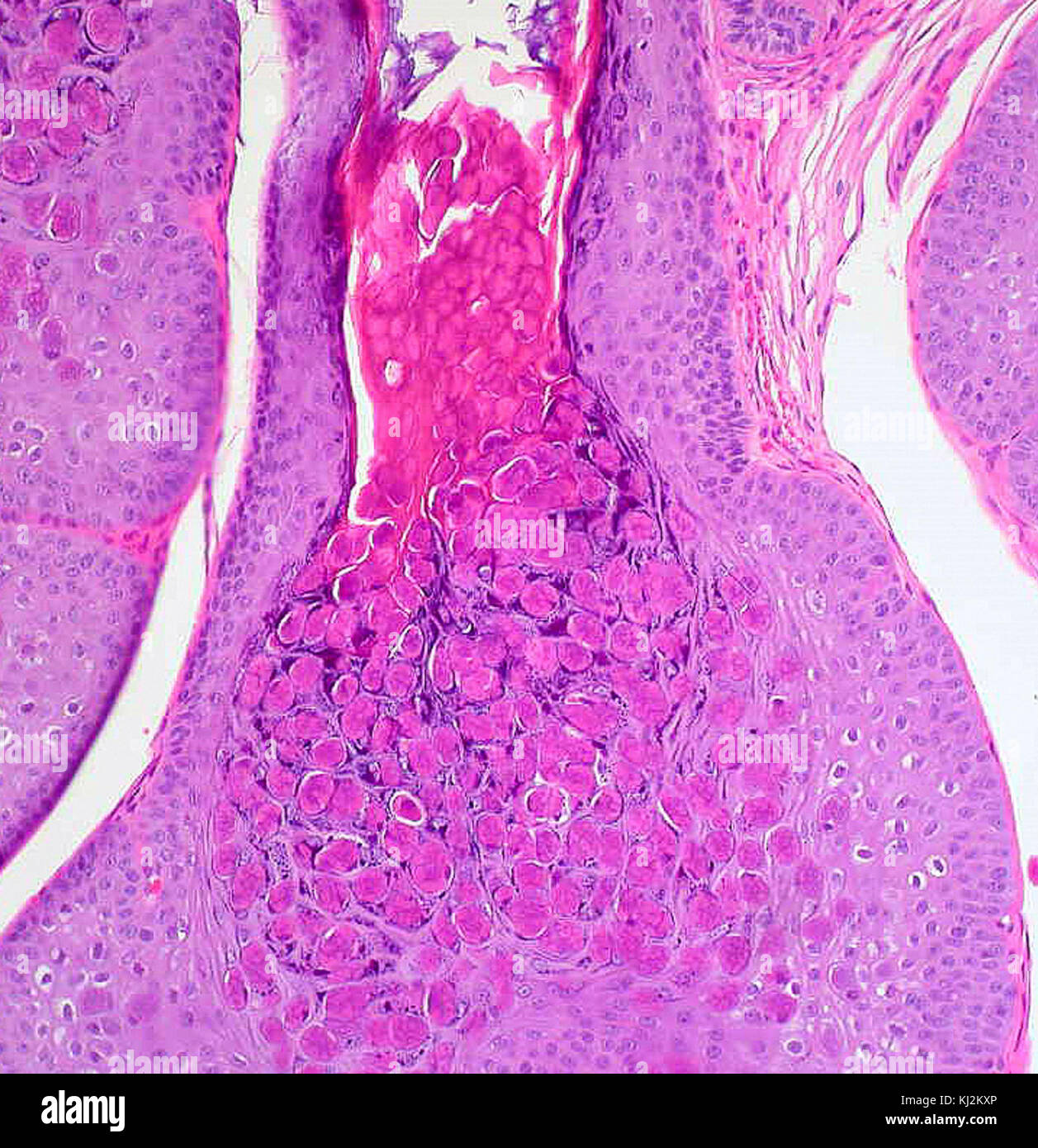 Le molluscum contagiosum 3 Banque D'Images