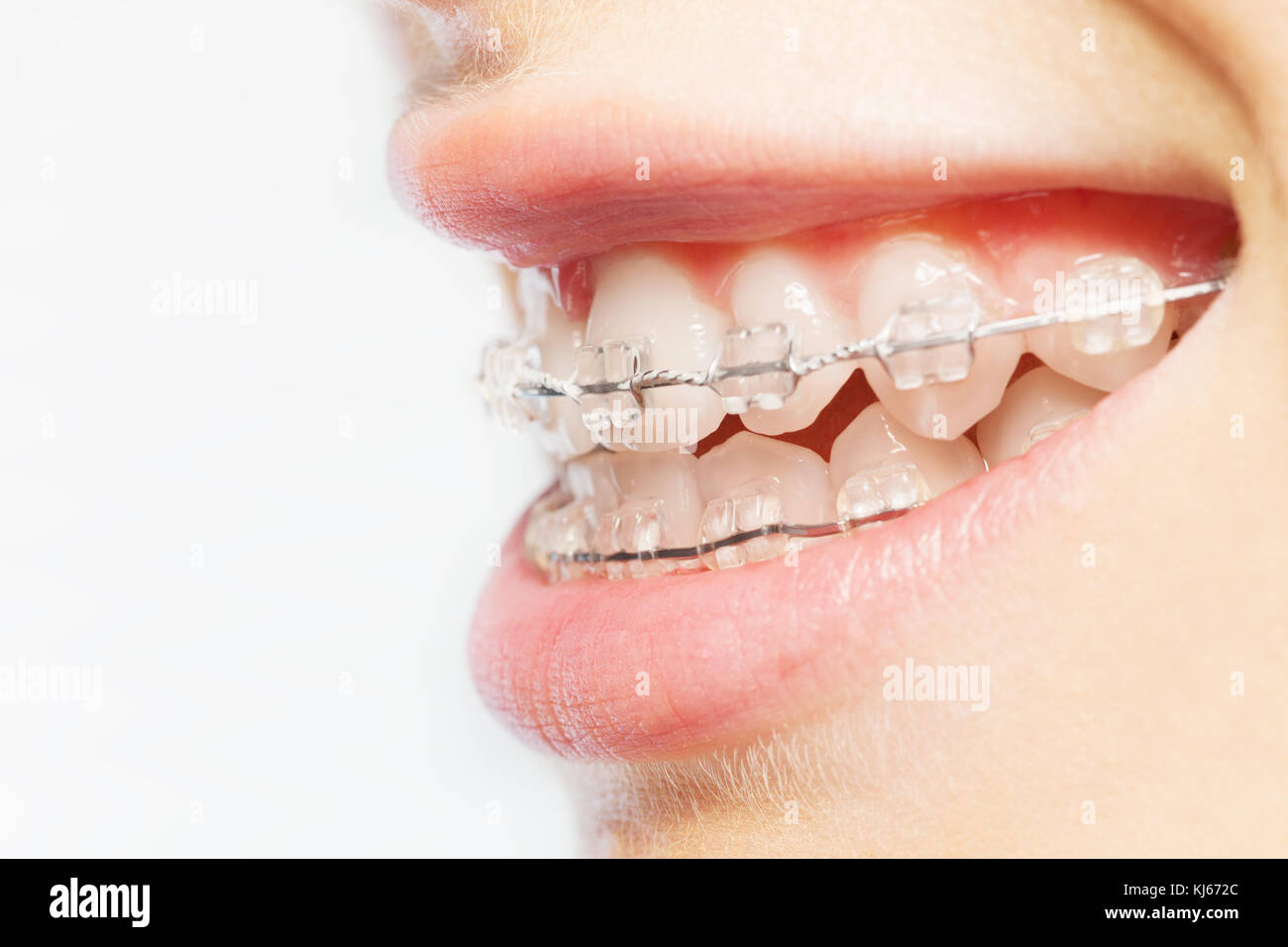 Close-up photo de dents avec des appareils orthodontiques contre fond noir Banque D'Images