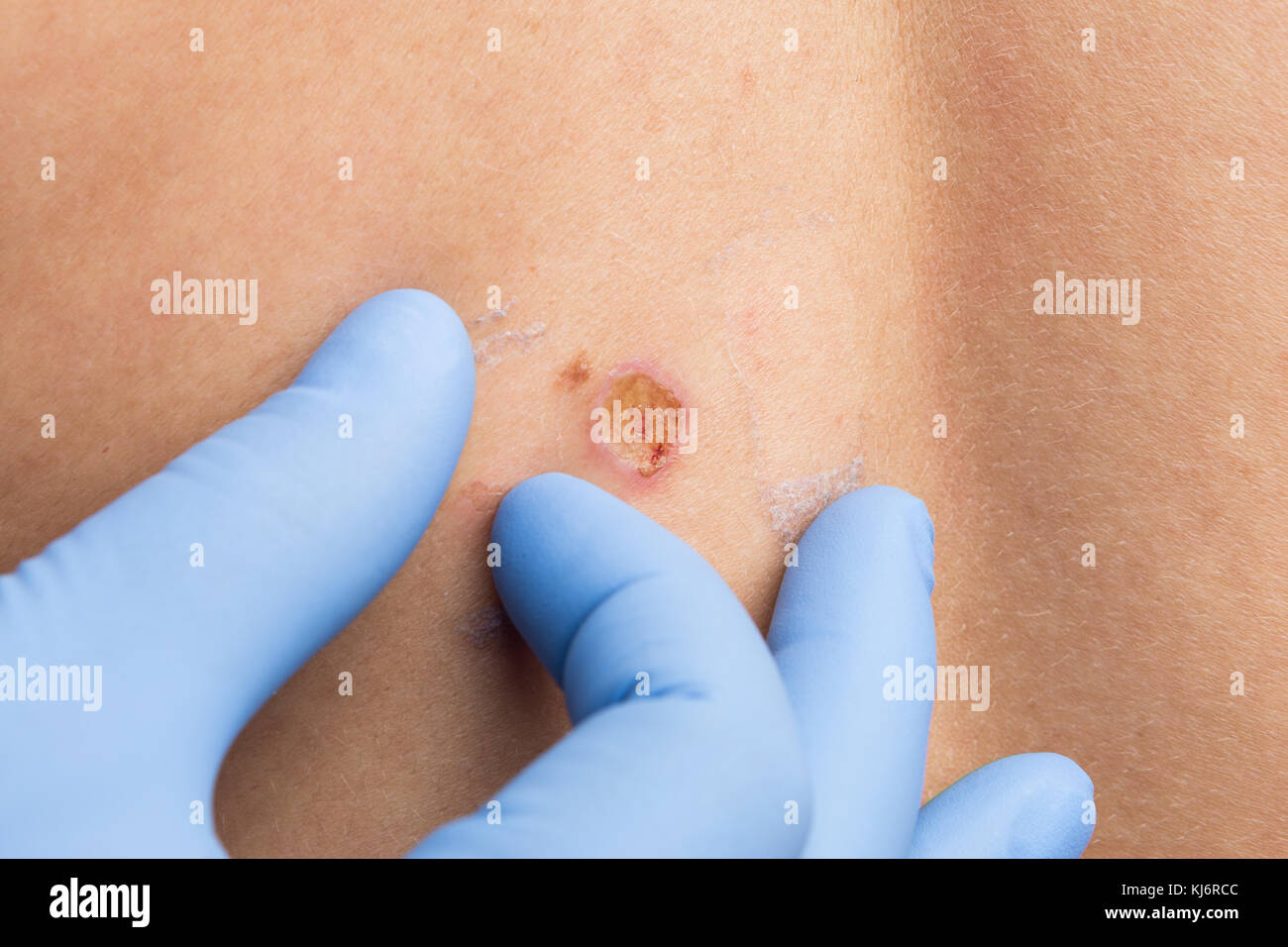 L'enlèvement des moisissures concept avec médecin mains un examen de la peau après une chirurgie au laser Banque D'Images