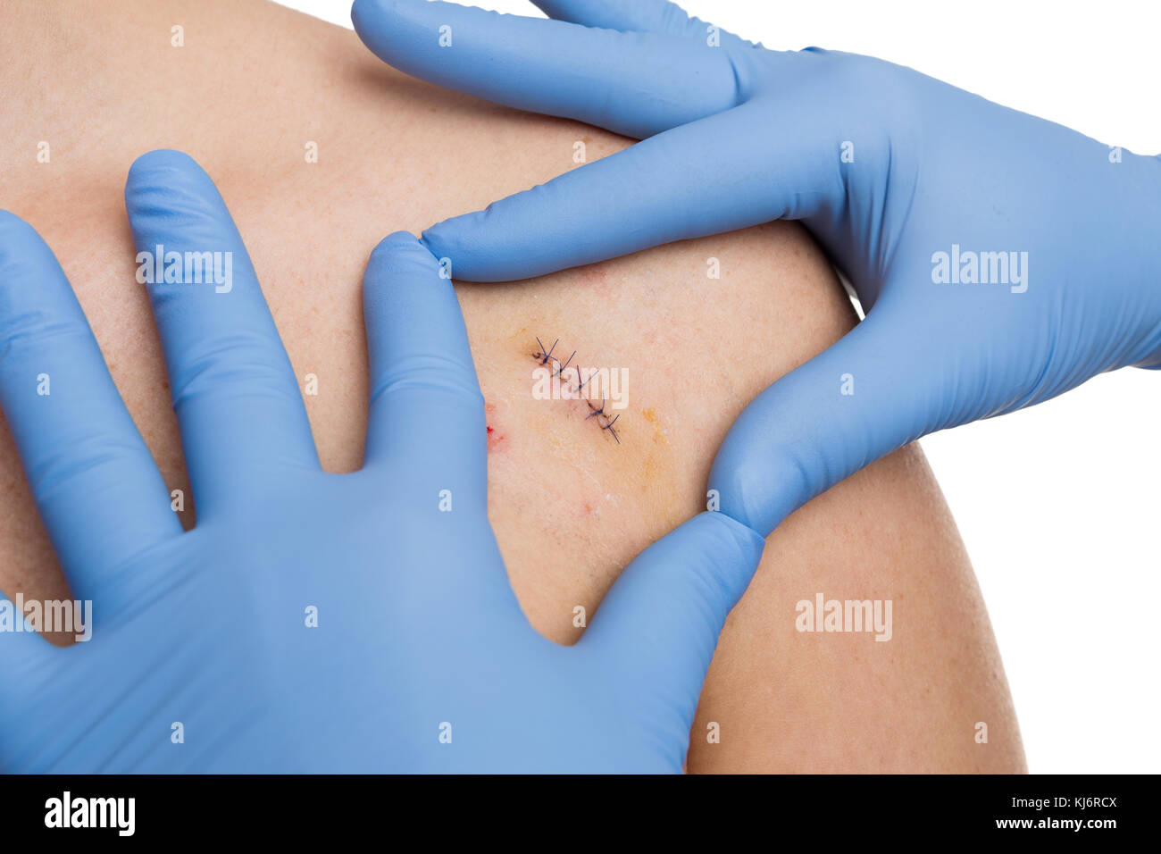 Médecin chirurgie plastique cousu mains ossature bois après incision de la procédure de dépose du moule à l'aide de gants stériles en latex Banque D'Images
