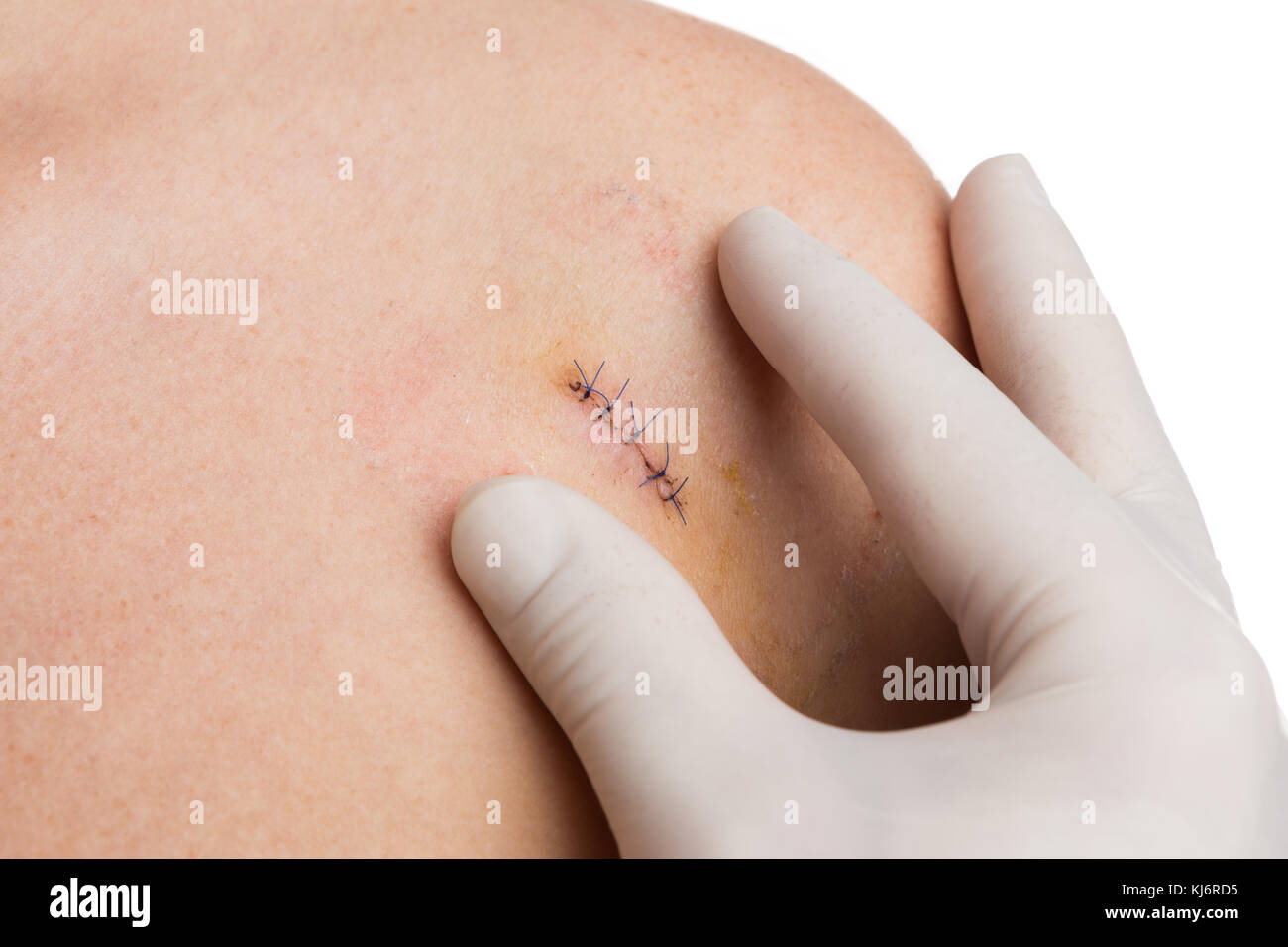 Infirmière ou infirmier examine les mains sur la suture douce femme épaule après chirurgie de déplacement de marque ou du moule Banque D'Images