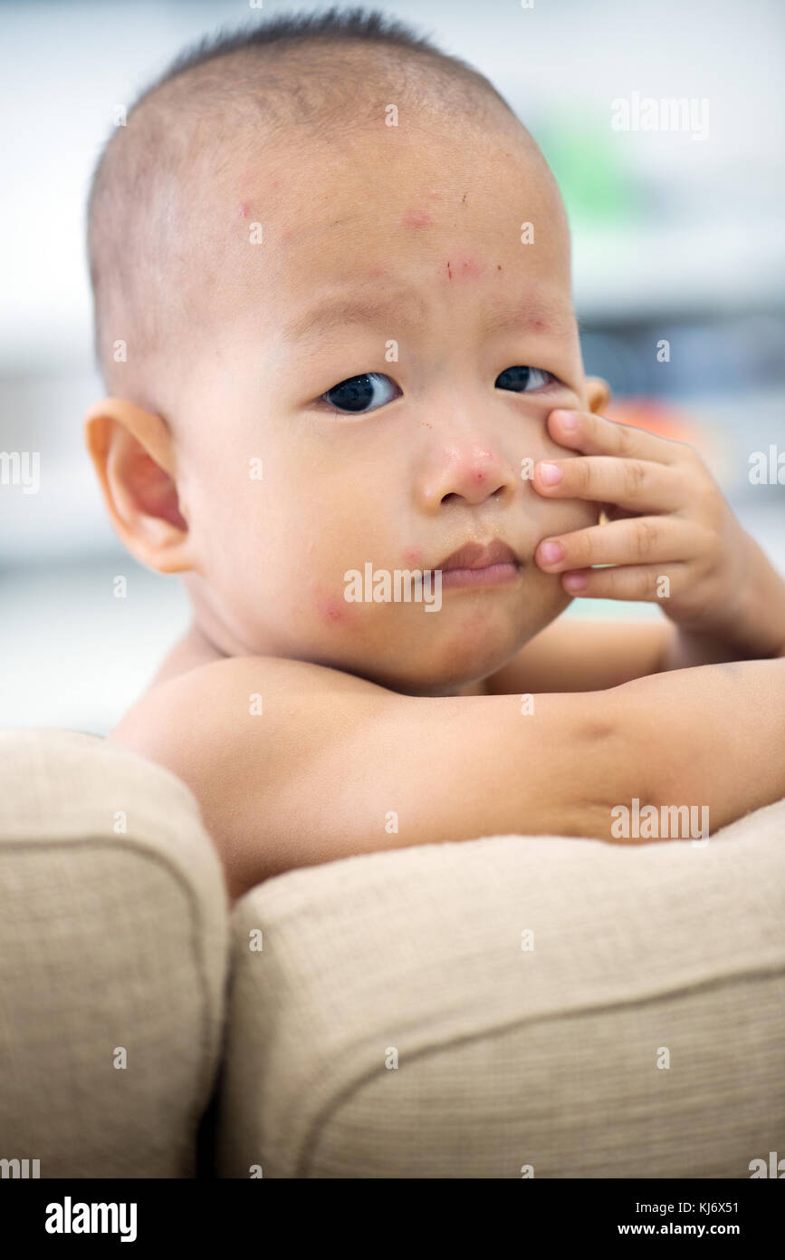 Asian baby sitting sur table avec les éruptions de varicelle, photo naturelle. Banque D'Images