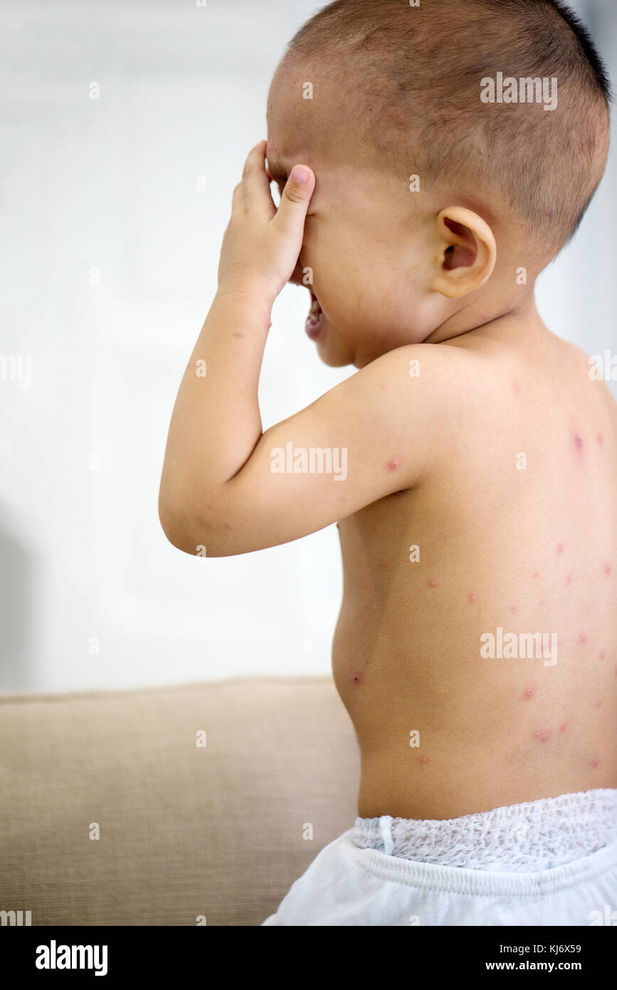 Bebe Asiatique Avec Les Eruptions De Varicelle De Pleurer Photo Stock Alamy
