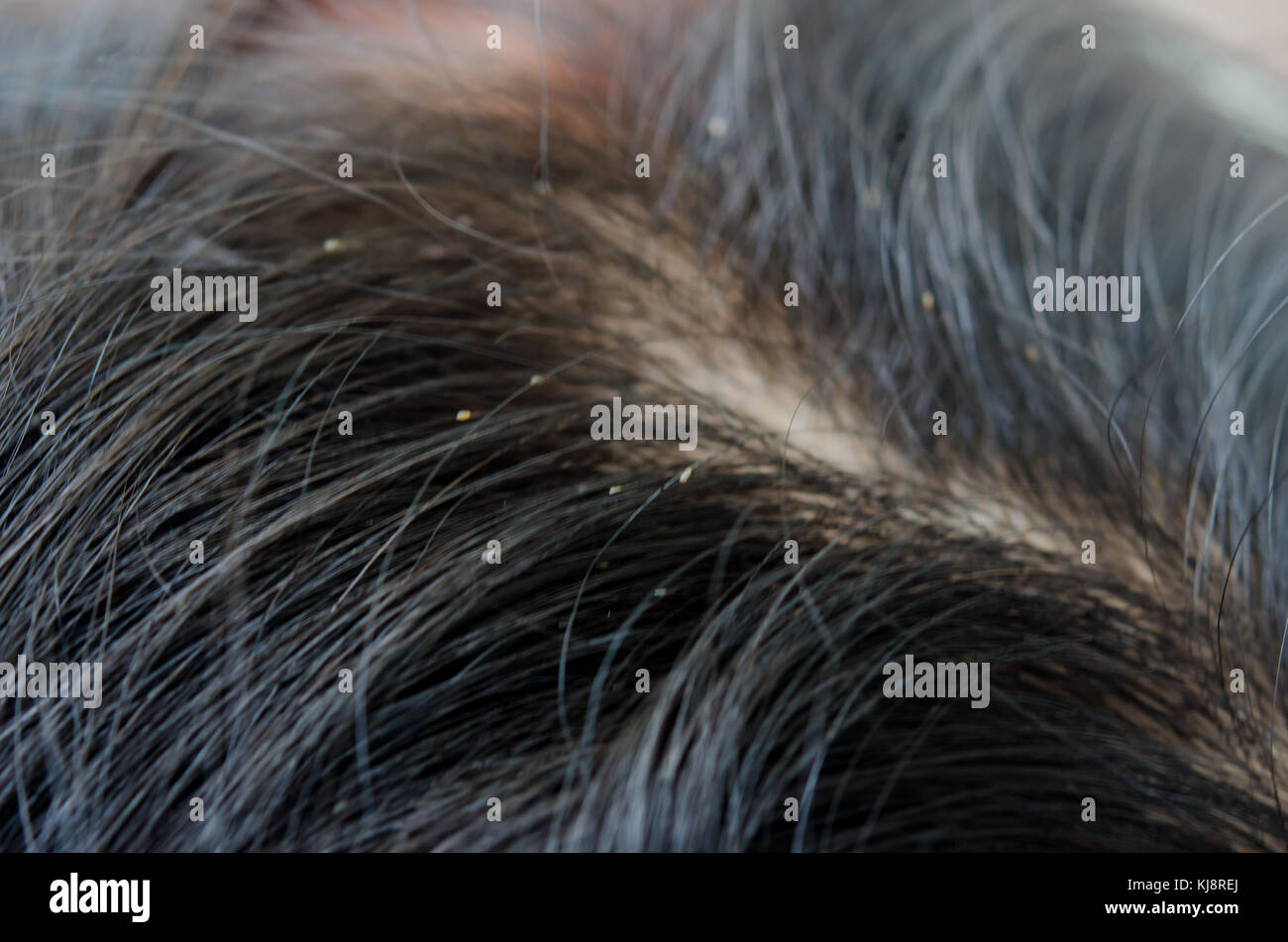 Oeufs de poux sur la tête de cheveux causes de démangeaisons Photo Stock Alamy
