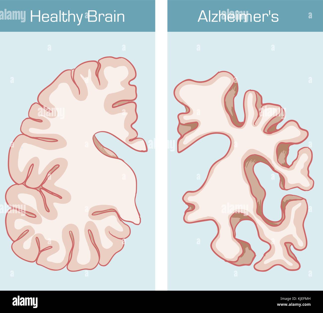 La maladie d'Alzheimer est une maladie qui touche le cerveau Image ...
