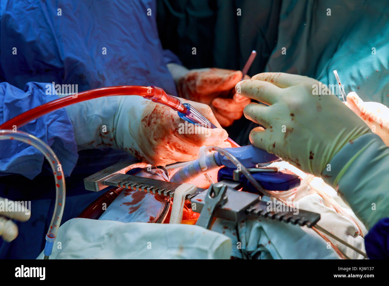 Équipe de chirurgiens et d'un bistouri électrique à l'aide de pinces pour minithoracotomy intervention close-up, cordon ouvert Chirurgie cardiaque Chirurgie minimalement invasive. Banque D'Images