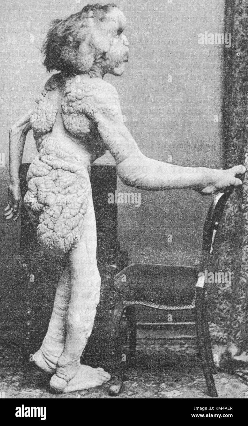 Joseph Carey Merrick, l'homme anglais avec des malformations très graves connu comme le 'Elephant man', Banque D'Images