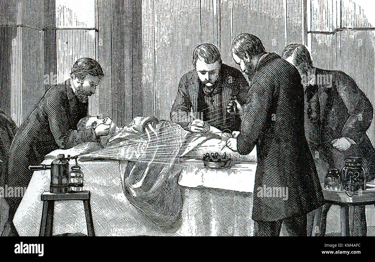 Joseph Lister vaporisant du phénol sur la plaie pendant que les médecins effectuent une opération Banque D'Images
