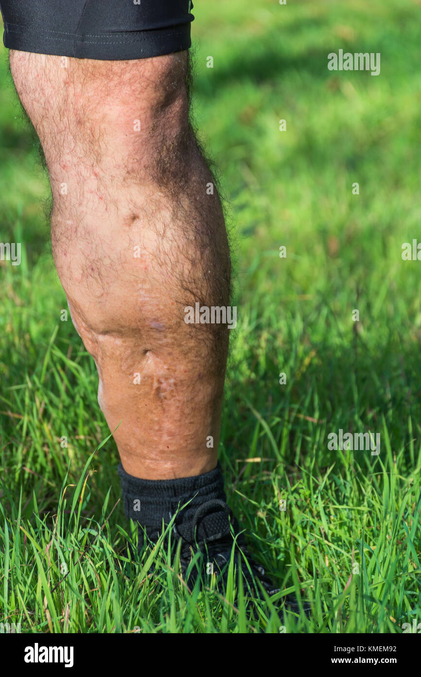 Vieille cicatrice de blessure à la jambe, de voiture ou d
