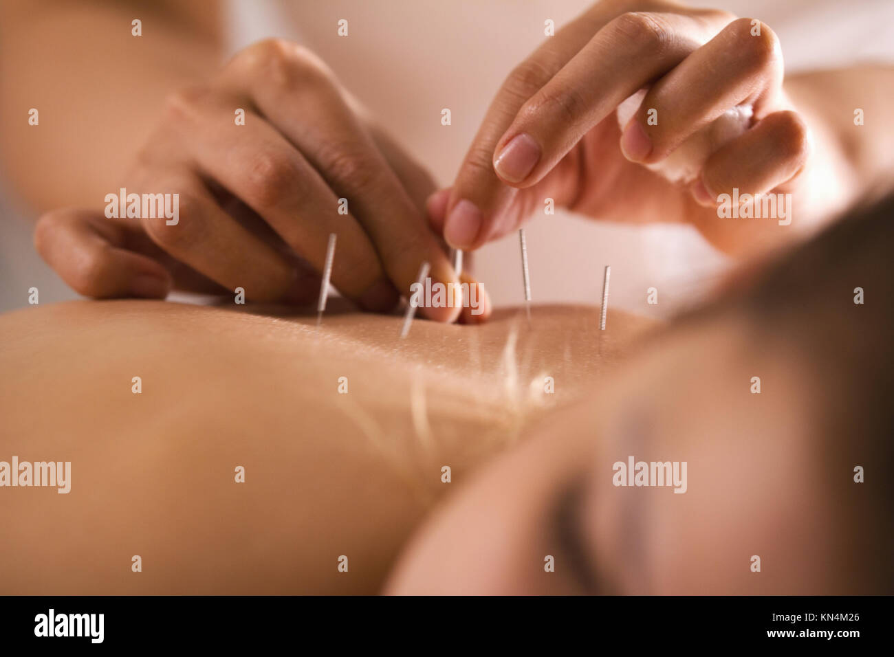 Le médecin en aiguilles dans le corps de la jeune fille sur l'acupuncture  Photo Stock - Alamy