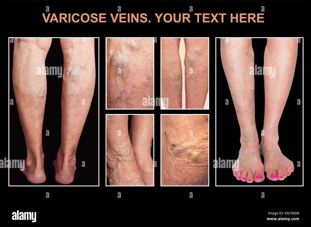 Douloureux varices, varicosités, varices, sur une jambe féminine. Le  vieillissement, la maladie de la vieillesse, problème esthétique concept  Photo Stock - Alamy