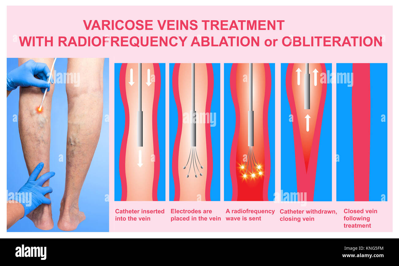 Varices. Le traitement par ablation par radiofréquence d'orobliteration les  jambes des femmes Photo Stock - Alamy