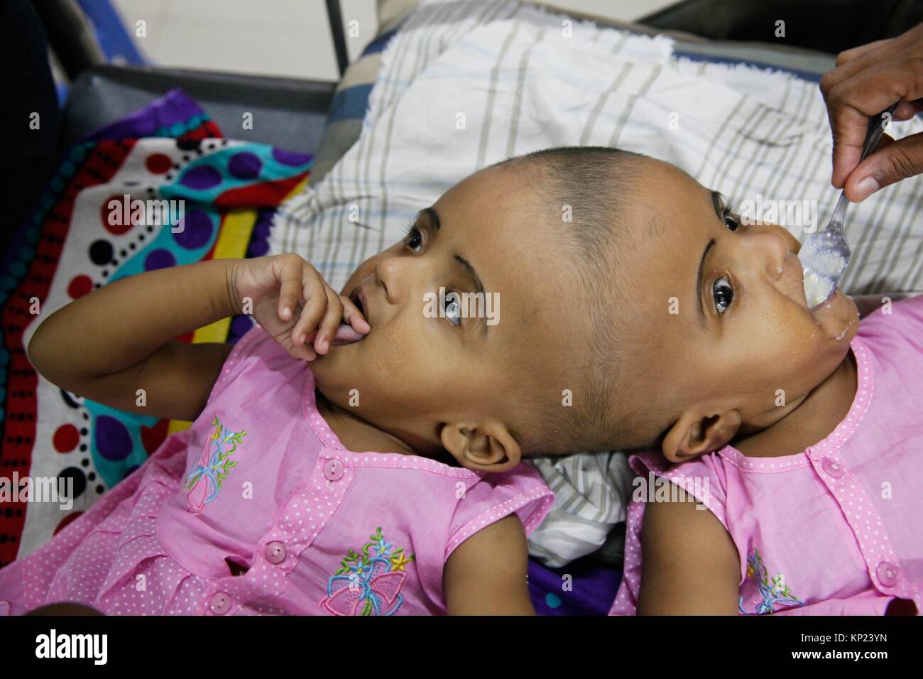 Bebe Filles Conjoined Twins Bangladais Rabia Et Rukia A Admis A L Hopital A Dhaka Le 24 Juillet 17 Livre Par Cesarienne A La Clinique De Pdc Photo Stock Alamy Bebe Filles Conjoined Twins Bangladais Rabia Et Rukia A Admis A L Hopital A Dhaka Le 24 Juillet 17 Livre Par Cesarienne A La Clinique De Pdc Photo Stock Alamy