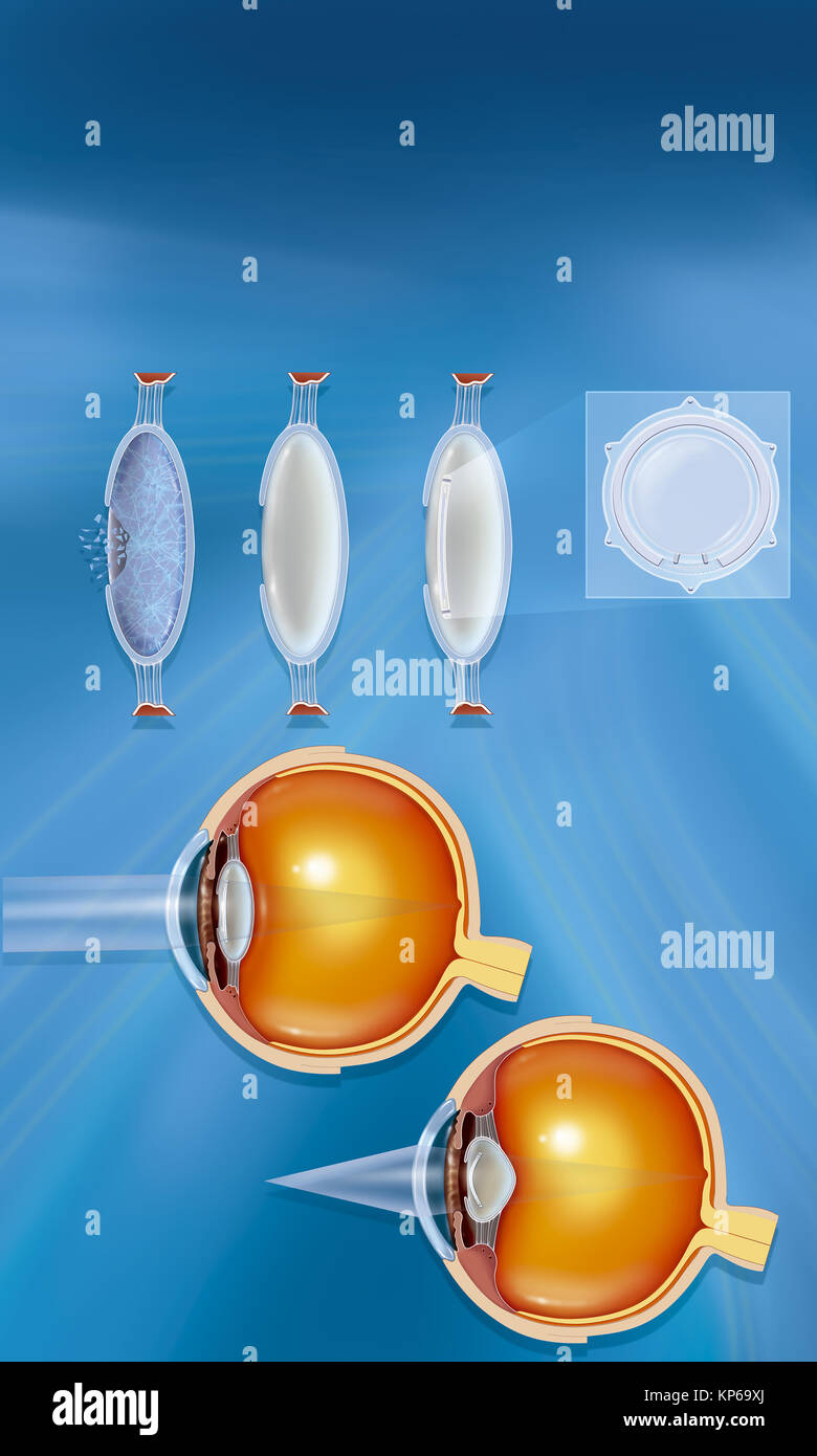 IMPLANT DE LENTILLES Banque D'Images