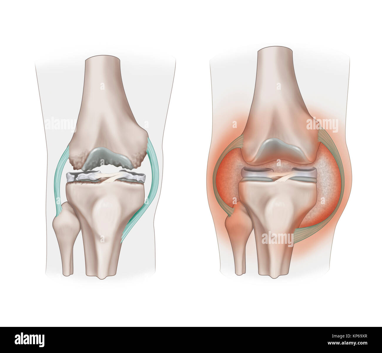 ARTHOPATHY ILLUSTRATION Banque D'Images