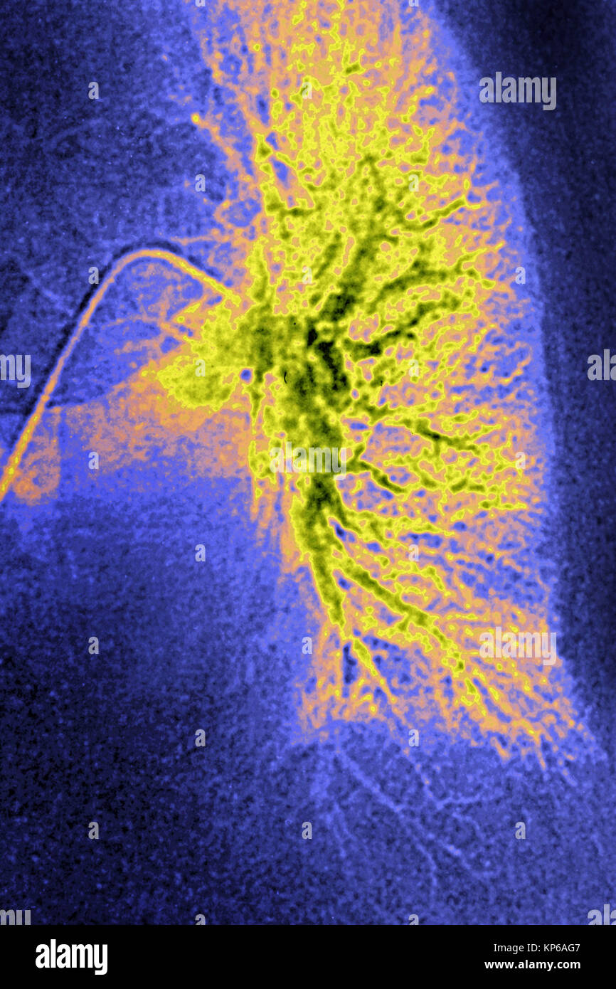 L'infarctus pulmonaire CORONAROGRAPHIE Banque D'Images