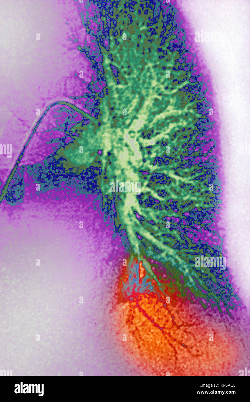 L'infarctus pulmonaire CORONAROGRAPHIE Banque D'Images
