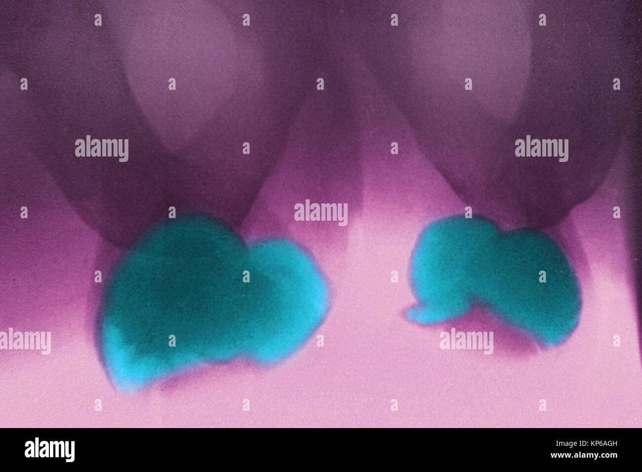 Kyste de l'épididyme, XRAY Photo Stock Alamy — free download