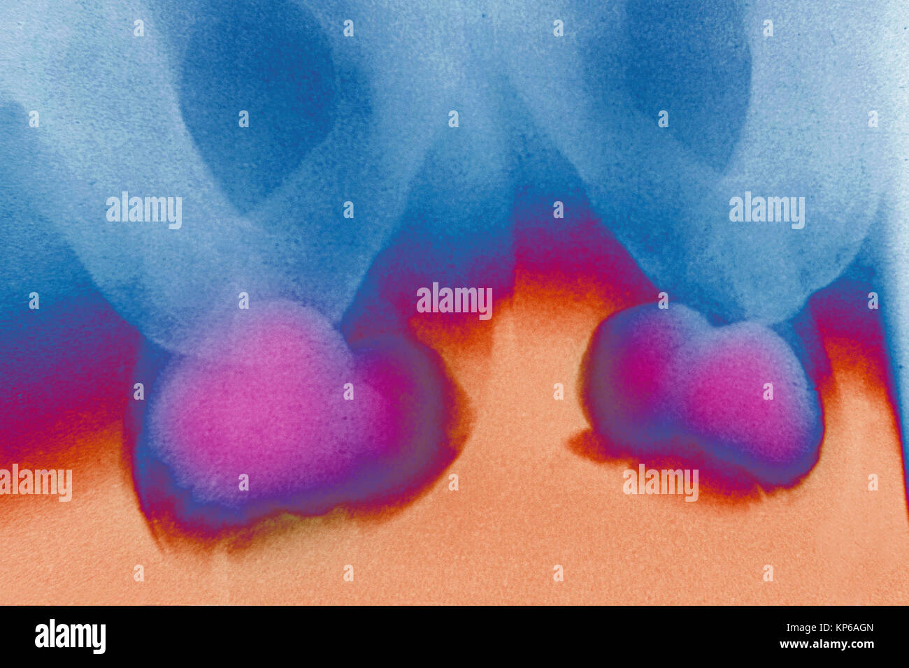 Kyste de l'épididyme, XRAY Photo Stock Alamy — free download