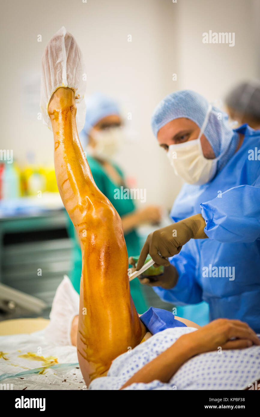 Traitement des varices par radiofréquence, l'hôpital de Dijon, France. Banque D'Images
