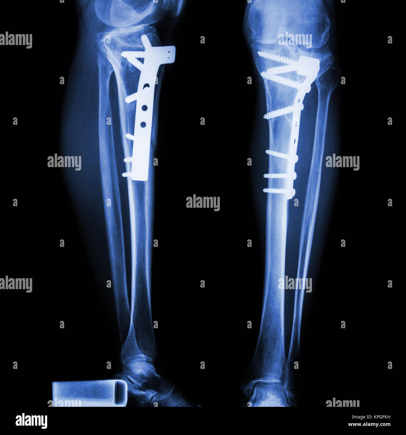 Tibia fracture de jambe(os). Il a été exploité et internes fixés par Banque D'Images