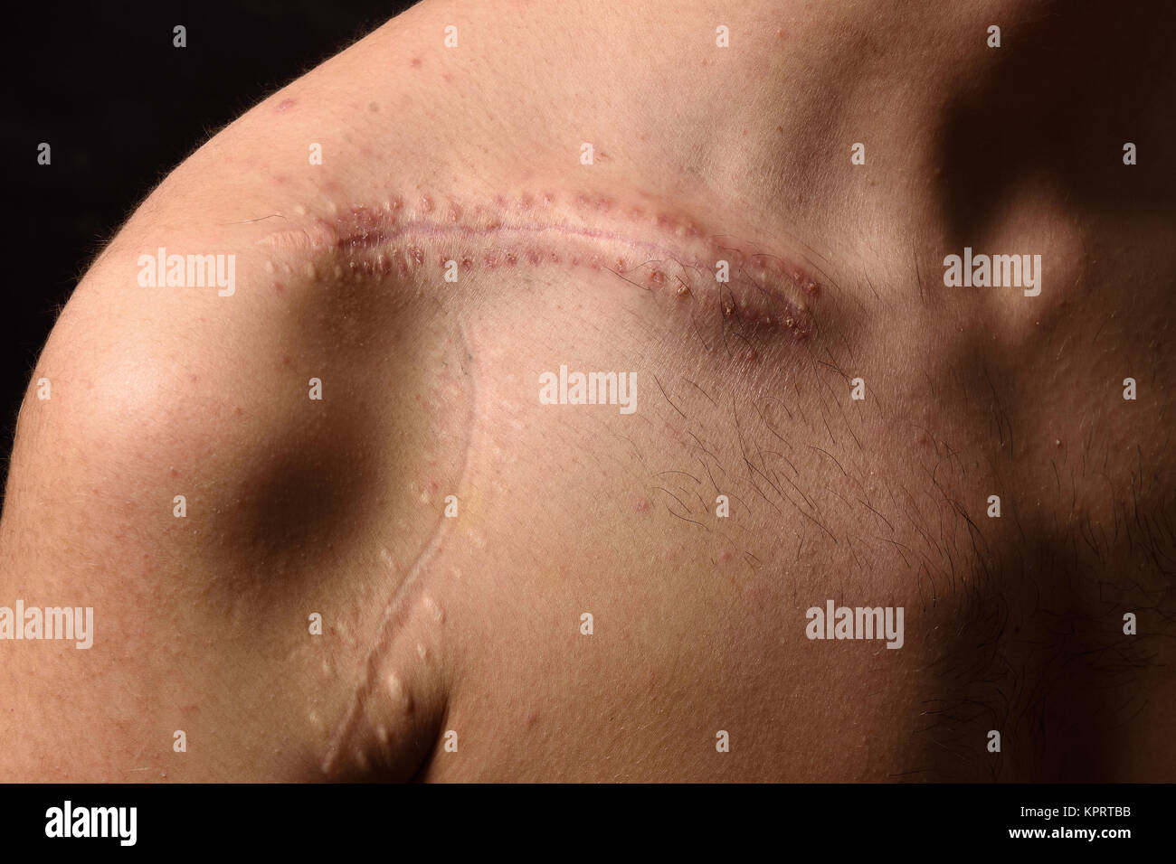 Détail d'une cicatrice sur la clavicule Photo Stock - Alamy