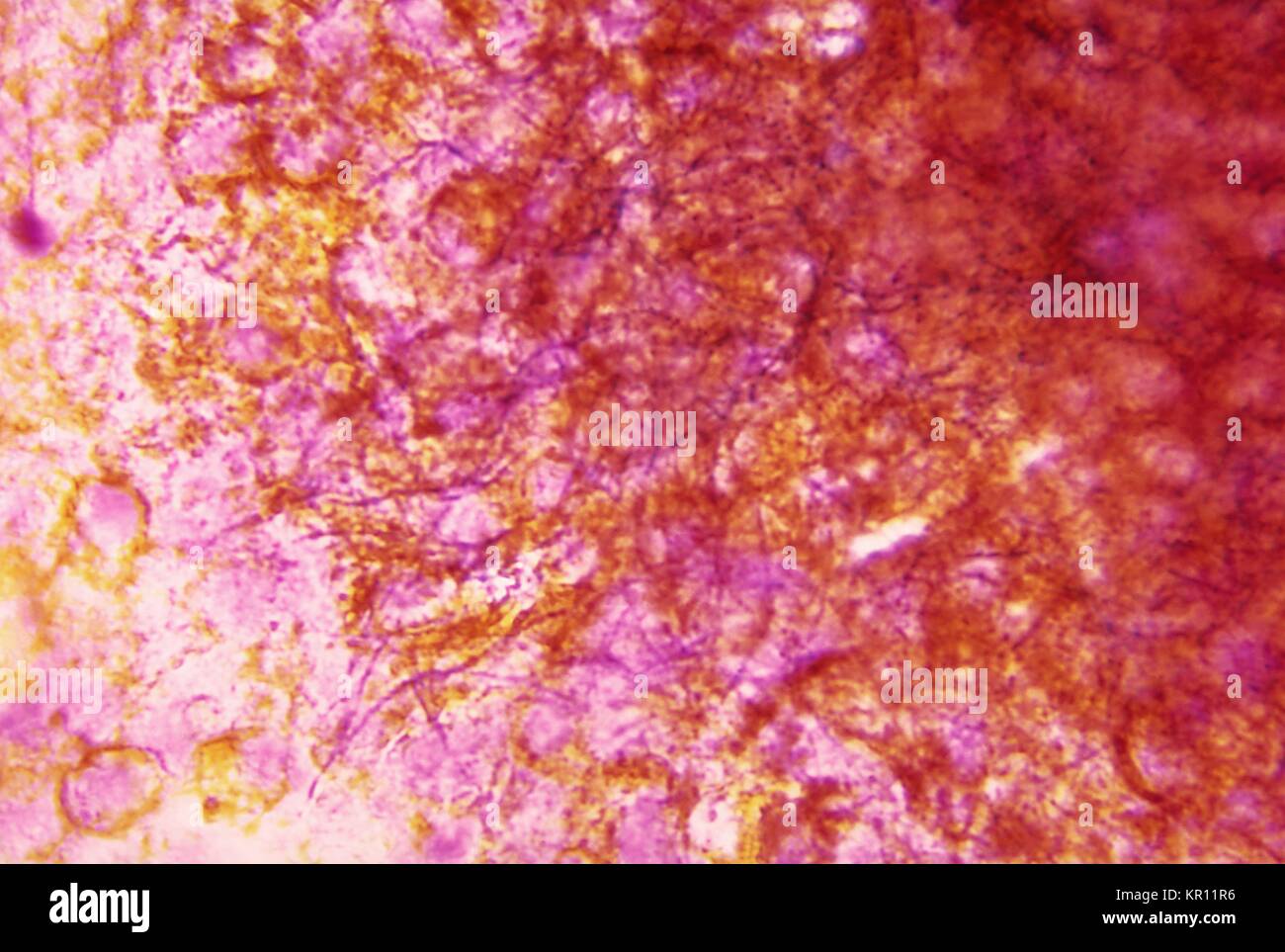 Cette microphotographie montre Nocardia brasiliensis trouvés dans un exsudat purulent d'une lésion à l'aide de la peau, coloration de gram 1973. Les bactéries du genre Nocardia spp. sont des bactéries Gram positif aérobies qui sont saprophytes et trouvé dans le sol, la matière organique en décomposition, et l'eau. Ces actinomycètes s'embranchent, perles, filamenteuses, les organismes. Image courtoisie CDC/Bill Causey. Banque D'Images