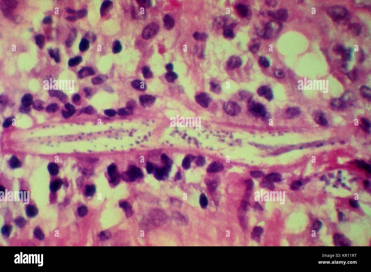 Cette microphotographie révèle un Strongyloides stercoralis parasite intégré dans la muqueuse intestinale, 1972. S. stercoralis est un nématode parasite qui infecte les humains, les primates, et les chiens. Le cycle de vie est complexe, alternant entre libres et parasites, cycles et comprend autoinfection et la multiplication à l'intérieur de l'hôte. Image courtoisie CDC/Dr. Fred Gilbert. Banque D'Images