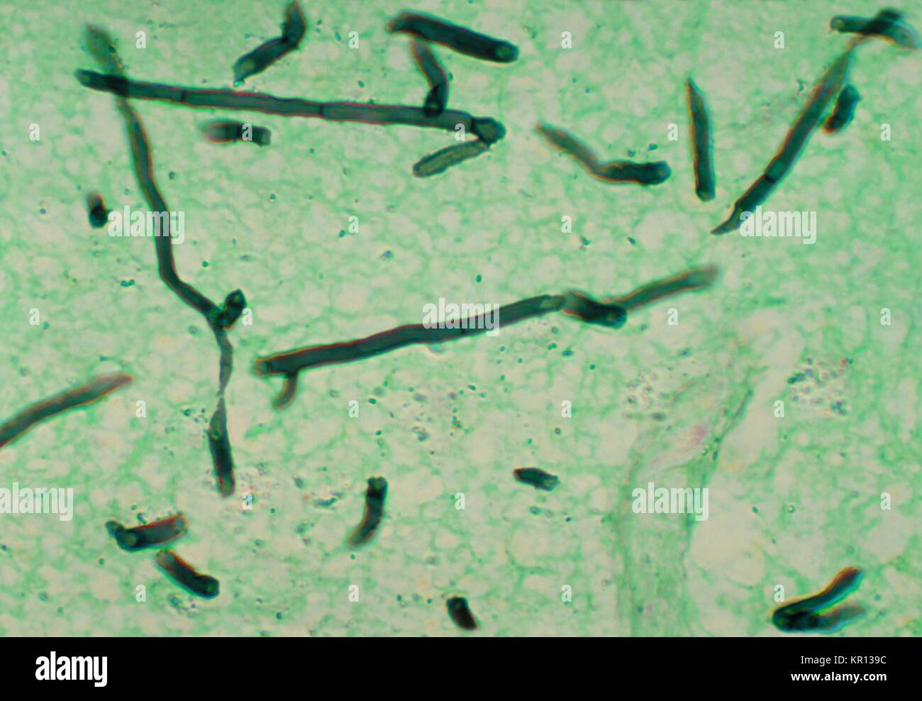 Micrographie d'un cerveau à l'aide d'un pigeon d'argent méthénamine teinté, révélant la présence du champignon Ochroconis gallopavum gallopava Dactylaria, autrefois, 1976. Gallopavum Ochroconis est un champignon, ou apparaissant sombre, ce qui provoque des infections cutanées ou sous-cutanée, et est plus susceptible d'être associé à des infections du SNC qui sont généralement limitées au cerveau. Image courtoisie CDC/Dr. Libero Ajello. Banque D'Images