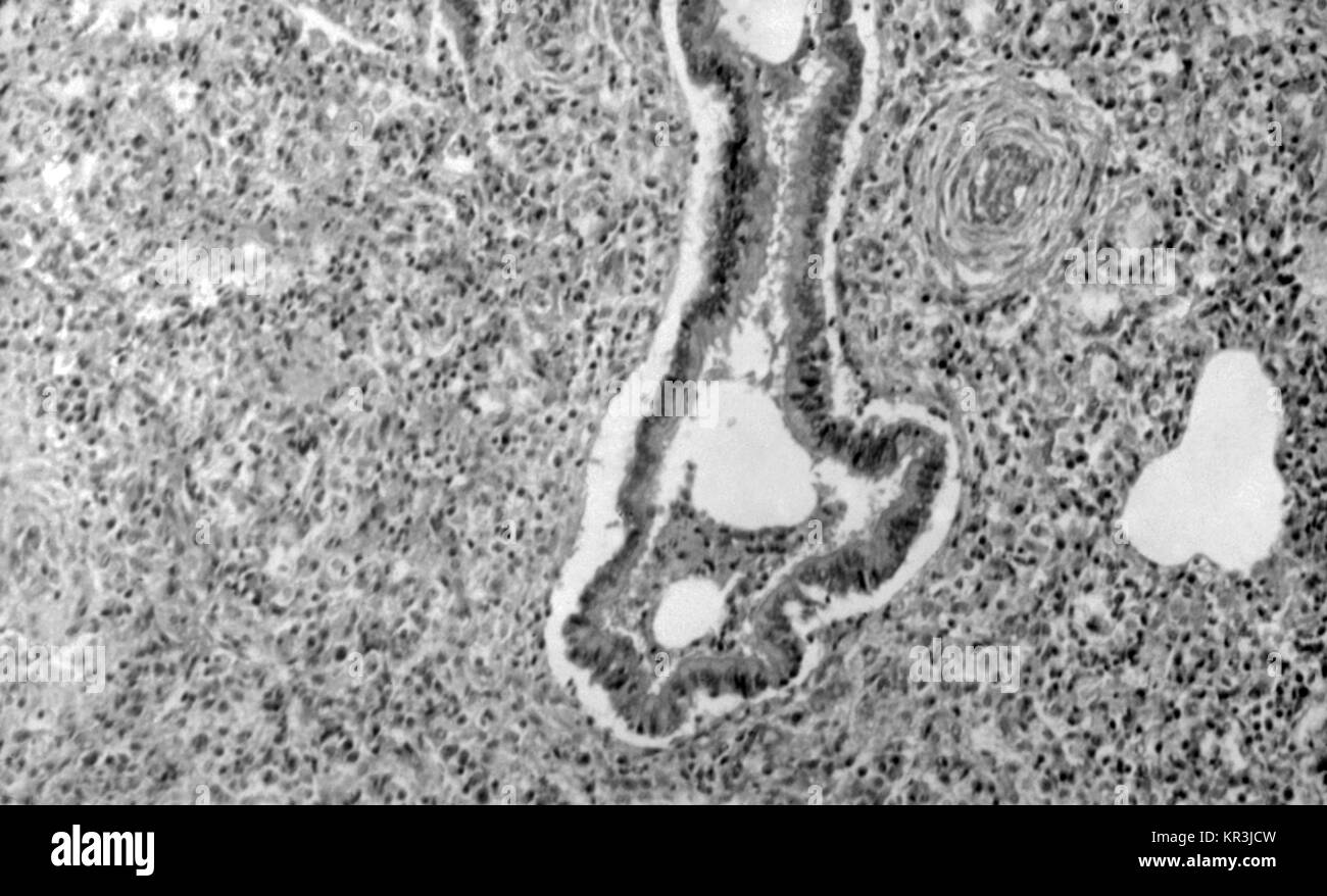 Une photomicrographie de tissu pulmonaire révélant la pneumonie Alba, qui est causée par la syphilis congénitale. Un canal alvéolaire est vu dans le centre, 1971. Les alvéoles sont peu développés et ont des murs épais de façon marquée. Les macrophages sont présents dans les espaces alvéolaires, HandE tache, grossissement 100X. Image courtoisie CDC/Susan Lindsley. Banque D'Images