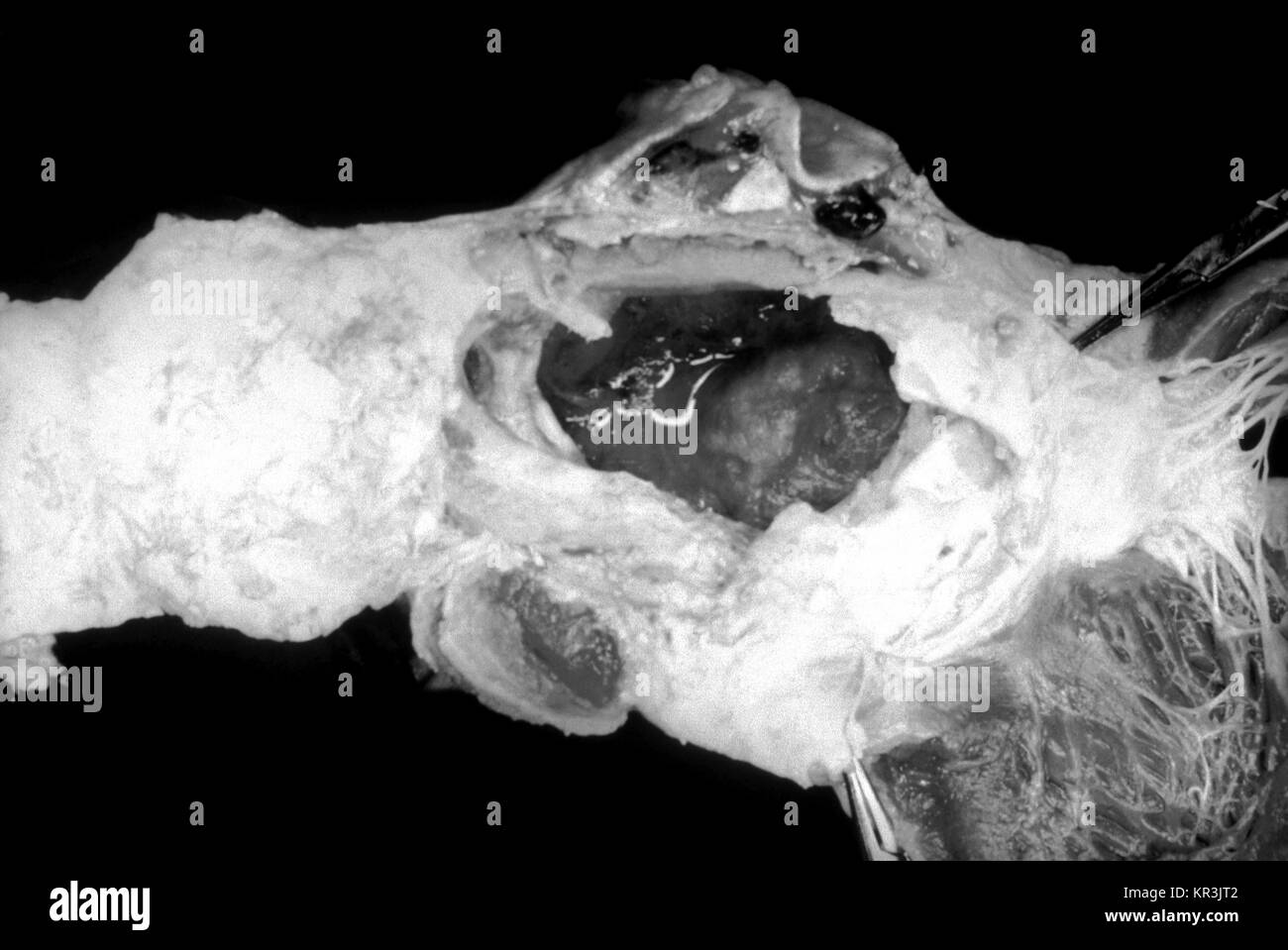 La rupture d'anévrisme aortique due à la syphilis cardiovasculaire. Cette image montre une grande rupture d'un anévrisme fusiforme, impliquant la partie ascendante de l'aorte, et il y a un caillot laminée entre le média et l'adventice tunicae, 1971. Remarque Le nacré blanc froissé tunica intima dans les zones distales à l'anévrysme. Image courtoisie CDC/Susan Lindsley. Banque D'Images
