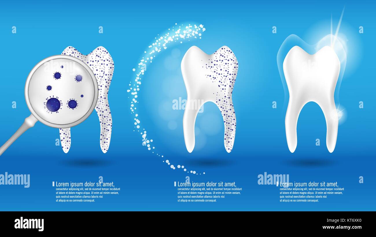 Le concept de la santé dentaire Vector set. 3D réaliste propre et brillant dents sale sur fond bleu, la compensation et le processus de blanchiment des dents. Oral Care, la restauration des dents Illustration de Vecteur