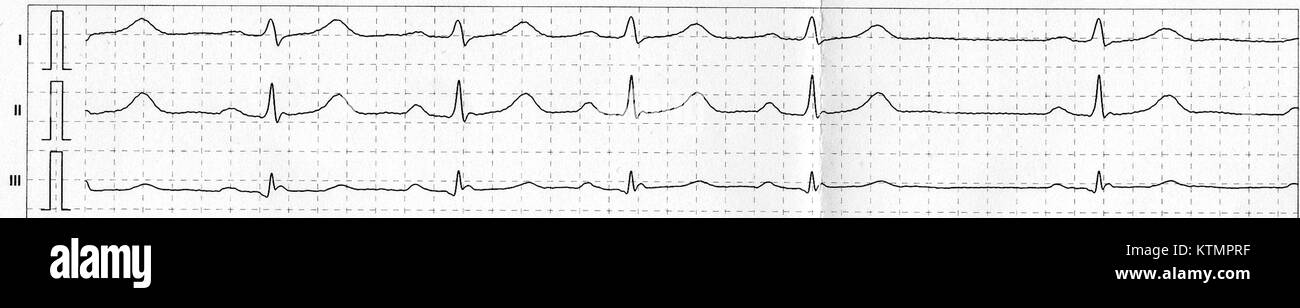 L'arythmie sinusale respiratoire (RSA) est un phénomène physiologique où la fréquence cardiaque varie en réponse à la respiration. Il est couramment observé pendant les états de respiration détendue ou profonde et est utilisé comme marqueur de la fonction du système nerveux autonome. Banque D'Images