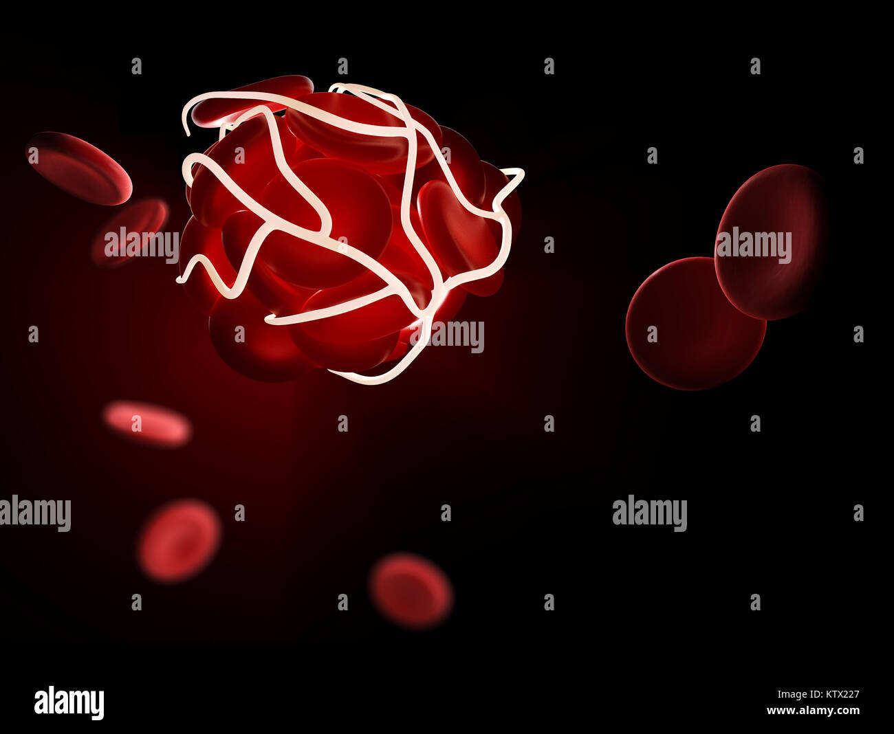 Caillot de sang et de thrombose, médicale 3d illustration concept un trouble de santé Banque D'Images