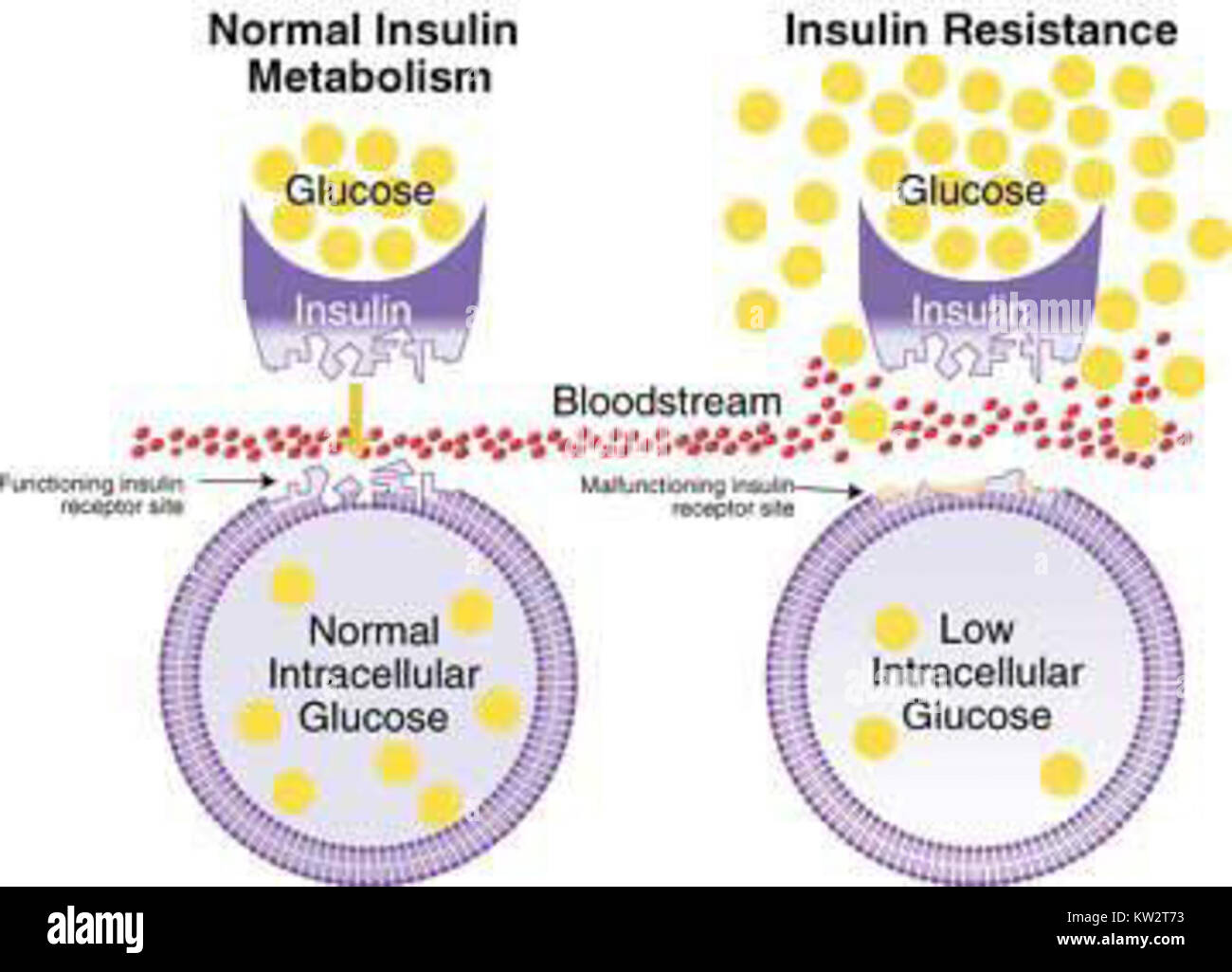 La résistance à l'insuline est une condition métabolique dans laquelle les cellules du corps deviennent moins sensibles à l'insuline, entraînant une augmentation du taux de sucre dans le sang. C'est un facteur clé dans le développement du diabète de type 2 et peut également être associé à l'obésité, l'hypertension et les maladies cardiovasculaires. La gestion de la résistance à l'insuline implique souvent des changements de mode de vie tels que l'alimentation, l'exercice et les médicaments. Banque D'Images