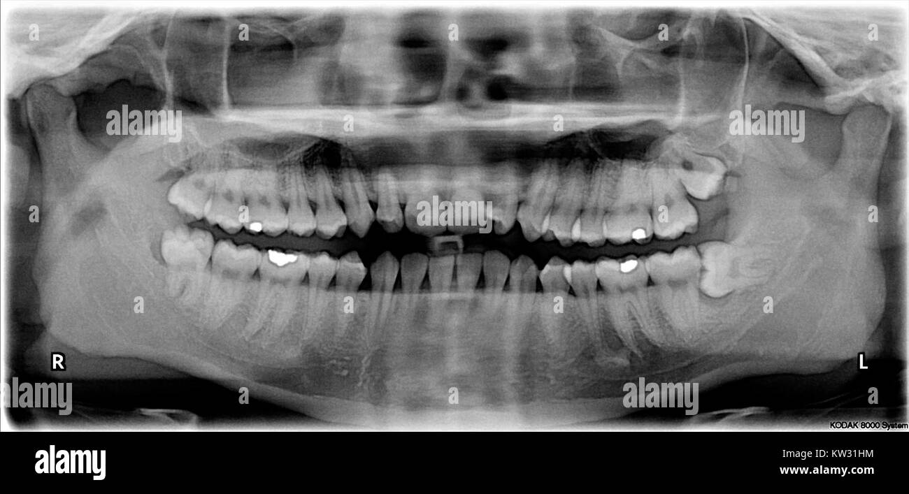 Les dents de sagesse incluses sont une condition dentaire dans laquelle les troisièmes molaires n'émergent pas correctement, nécessitant souvent une intervention chirurgicale pour la résolution. Banque D'Images