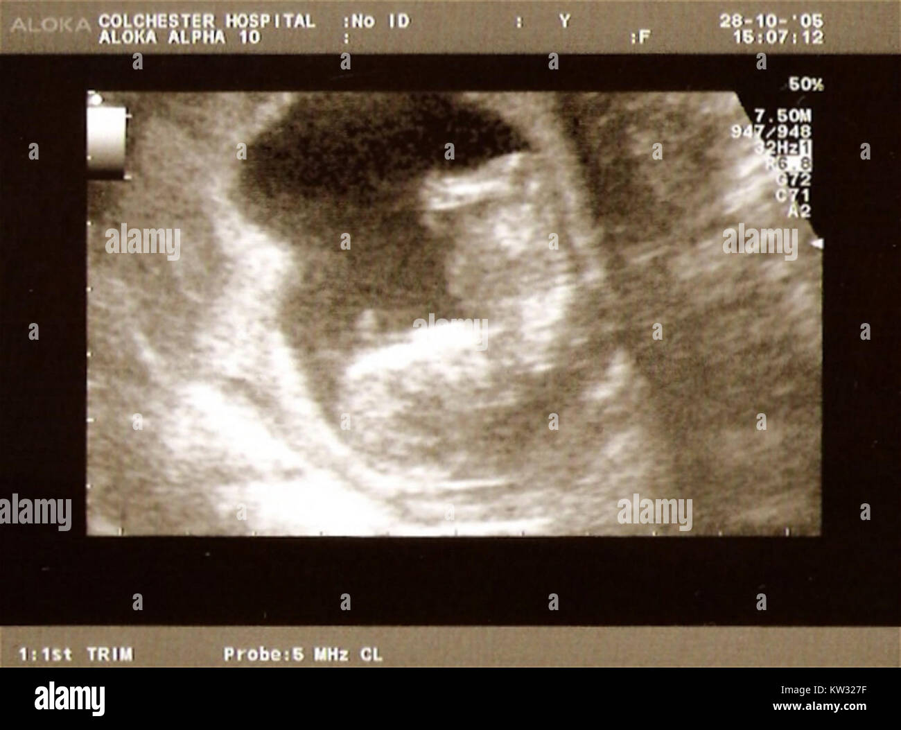 Une échographie de 12 semaines est effectuée entre 10 et 14 semaines de grossesse pour estimer la date d'échéance, vérifier le développement du bébé et dépister certaines conditions. Banque D'Images