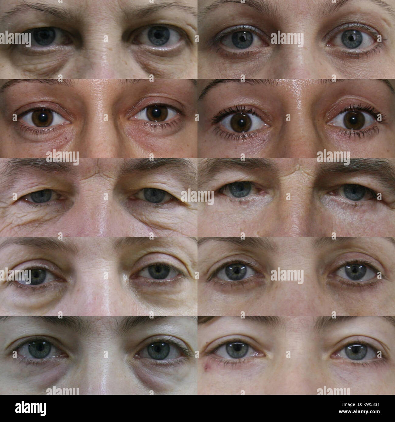 Une procédure médicale connue sous le nom de blépharoplastie, qui implique la modification chirurgicale des paupières. Cette procédure est souvent effectuée pour des raisons esthétiques ou fonctionnelles, améliorant l'apparence ou la vision. Banque D'Images