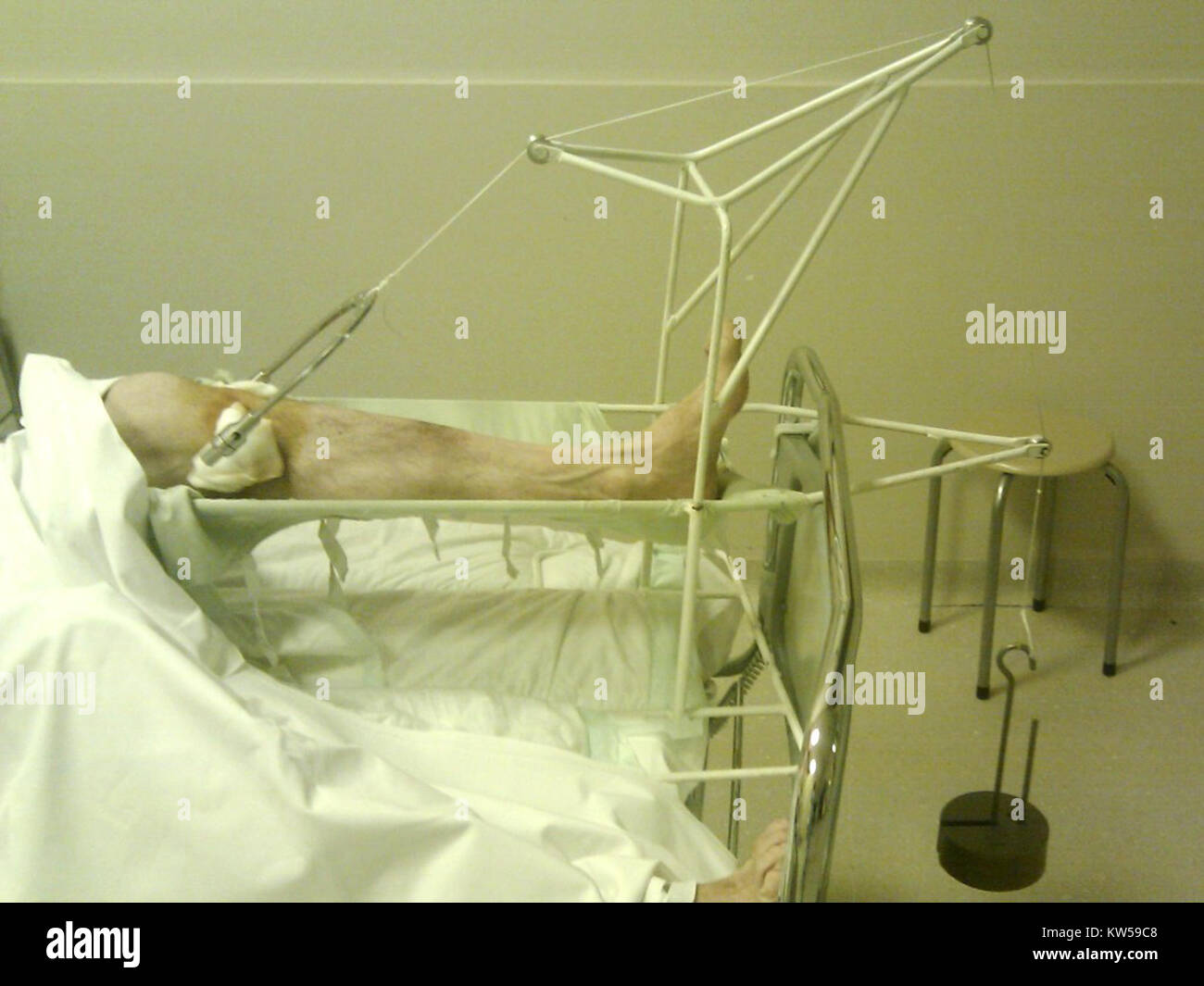 L'attelle de Bohler, avec extension, est un dispositif médical important utilisé dans le traitement des fractures. Cet exemple historique met en lumière l’évolution des outils orthopédiques au début du XXe siècle. Banque D'Images