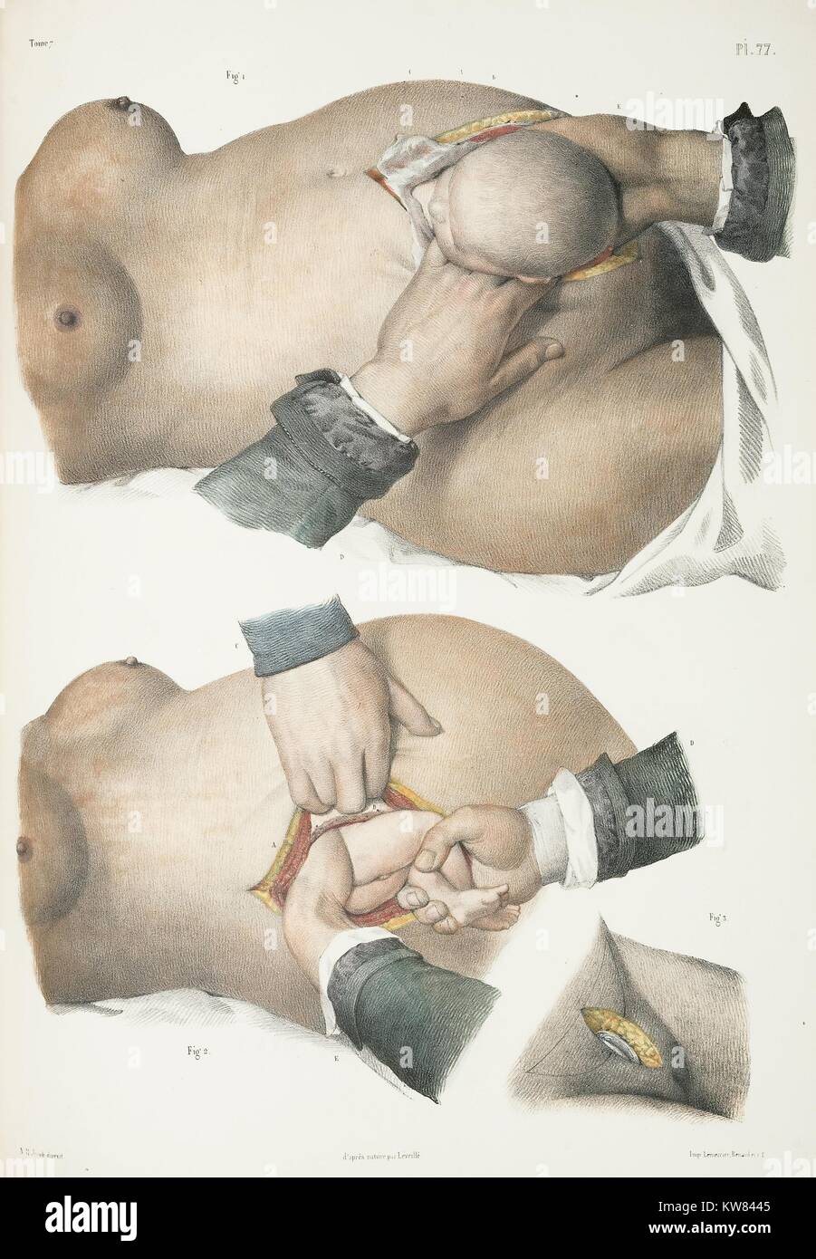 Deux illustrations montrant deux différentes méthodes de césarienne, 1900. Banque D'Images