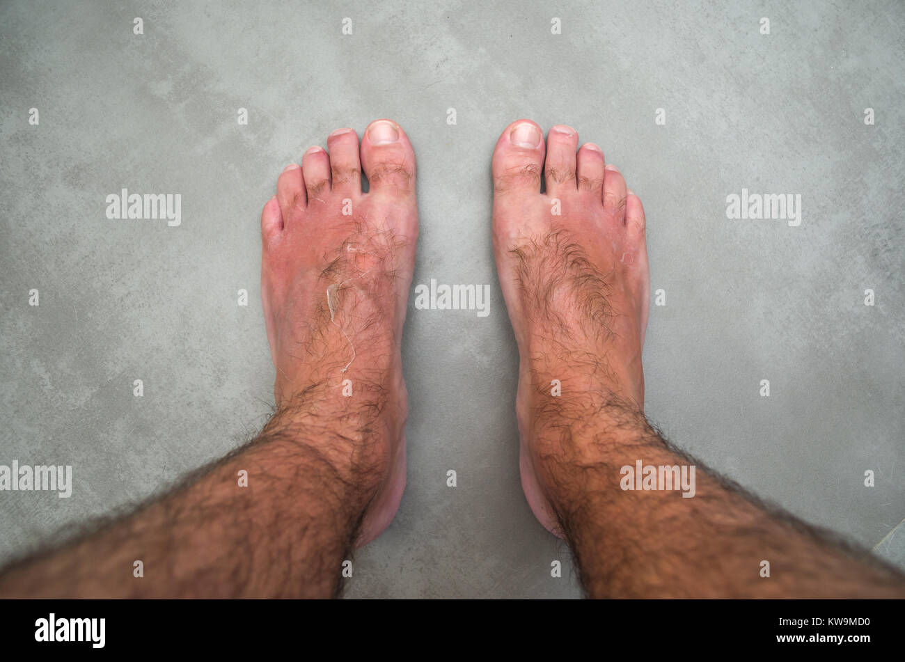 Coup De Soleil Jambes Impossible De Marcher Le coup de soleil sur les pieds de l'homme, de l'épluchage de la peau