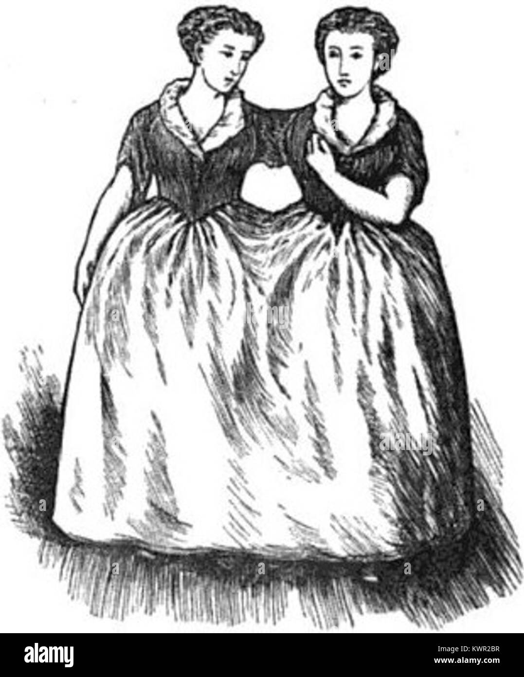 Les Biddenden Maids, présentées dans le numéro de 1869 du Gentleman's Magazine, étaient deux jumelles conjointes d'Angleterre. Leur histoire fait partie de l'histoire médicale et des discussions sociales du XIXe siècle. Banque D'Images