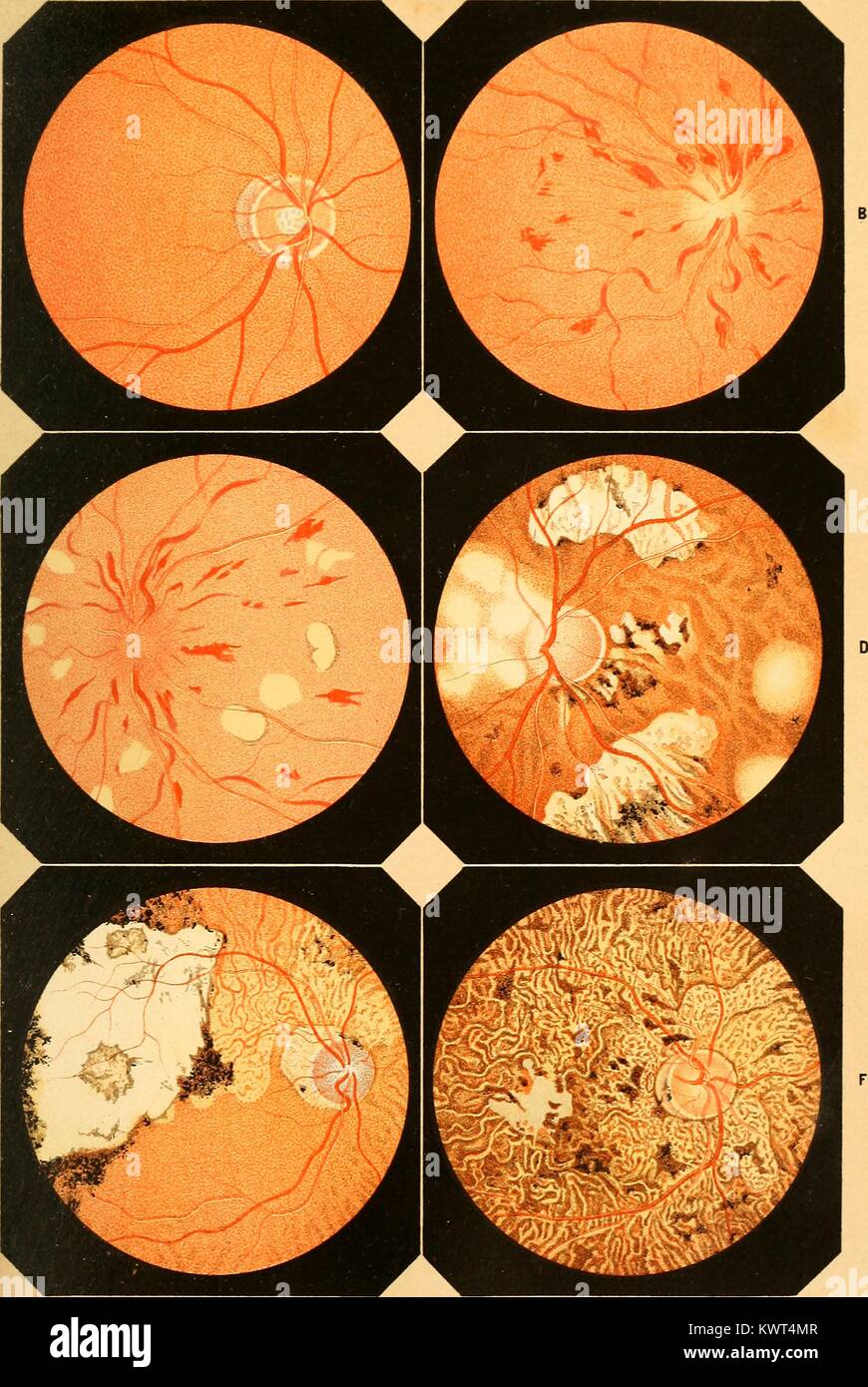 Illustration médicale représentant différentes maladies de l'oeil, ainsi que le nerf optique et les vaisseaux sanguins de l'œil, 1868. Avec la permission de Internet Archive. () Banque D'Images