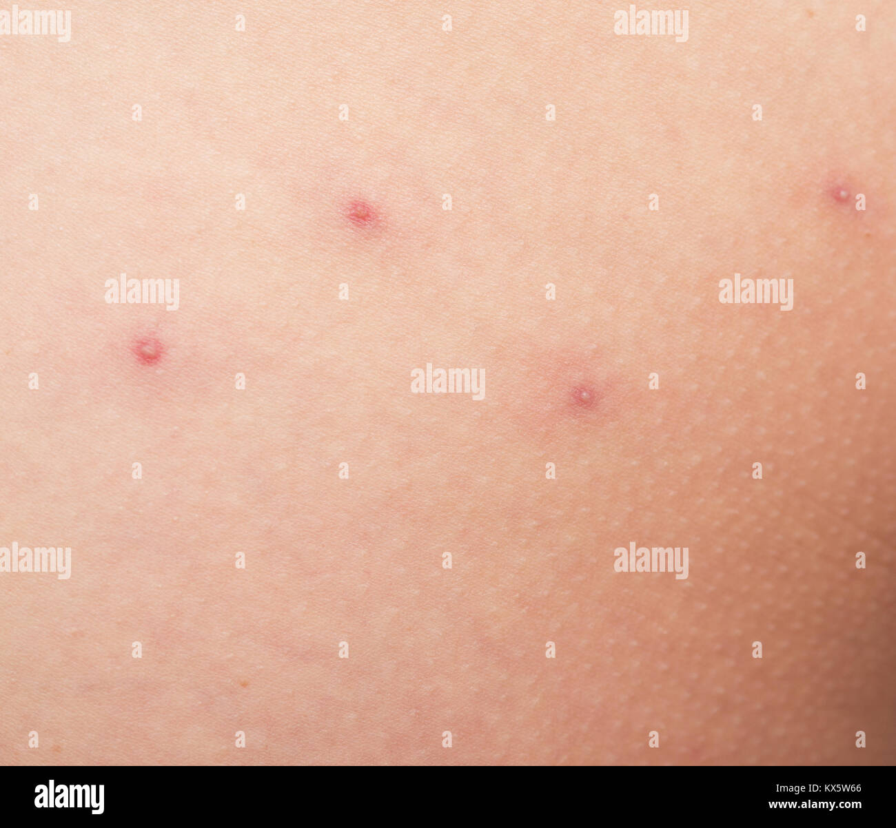 La Peau Humaine Avec Boutons Rouges Photo Stock Alamy La Peau Humaine Avec Boutons Rouges Photo Stock Alamy