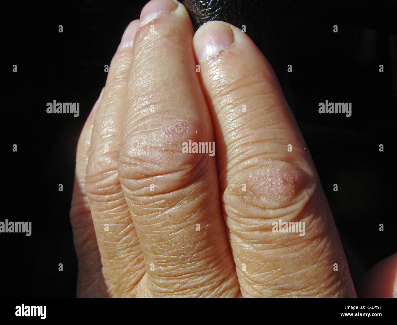 Trop sèche la peau fendue sur les articulations des doigts close ...
