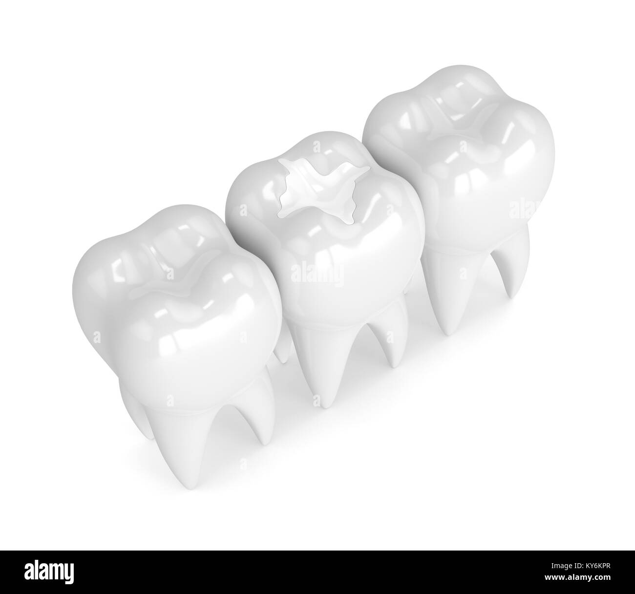 3D render of composite dentaire dents avec de la garniture sur fond blanc Banque D'Images