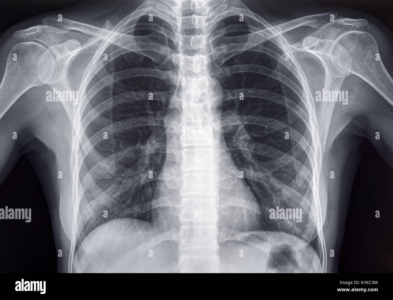 Radiographie pulmonaire d'un adulte femme humain Banque D'Images